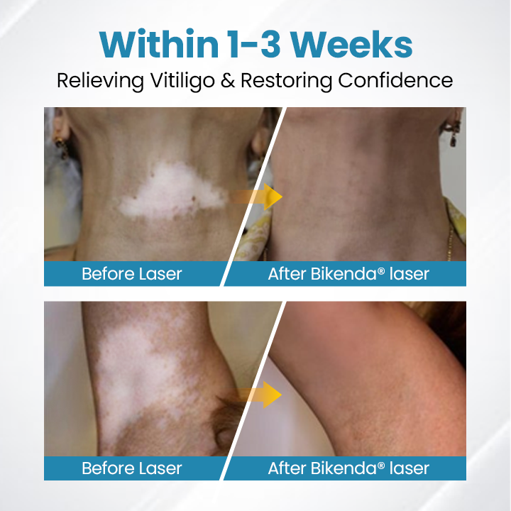 Bikenda® DermaBeam Vitiligo terápiás készülék