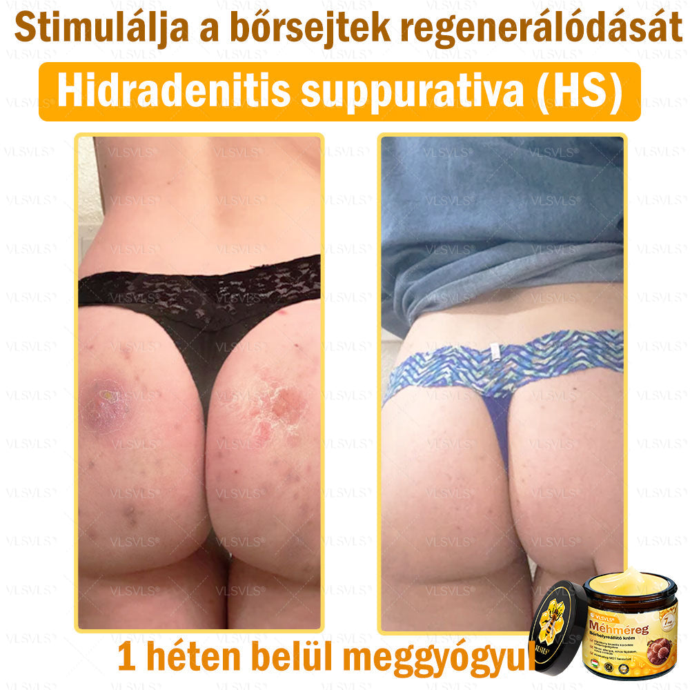 💪VLSVLS® Méhméreg Bőrhelyreállító Krém (👨⚕CE jóváhagyott)👍✅