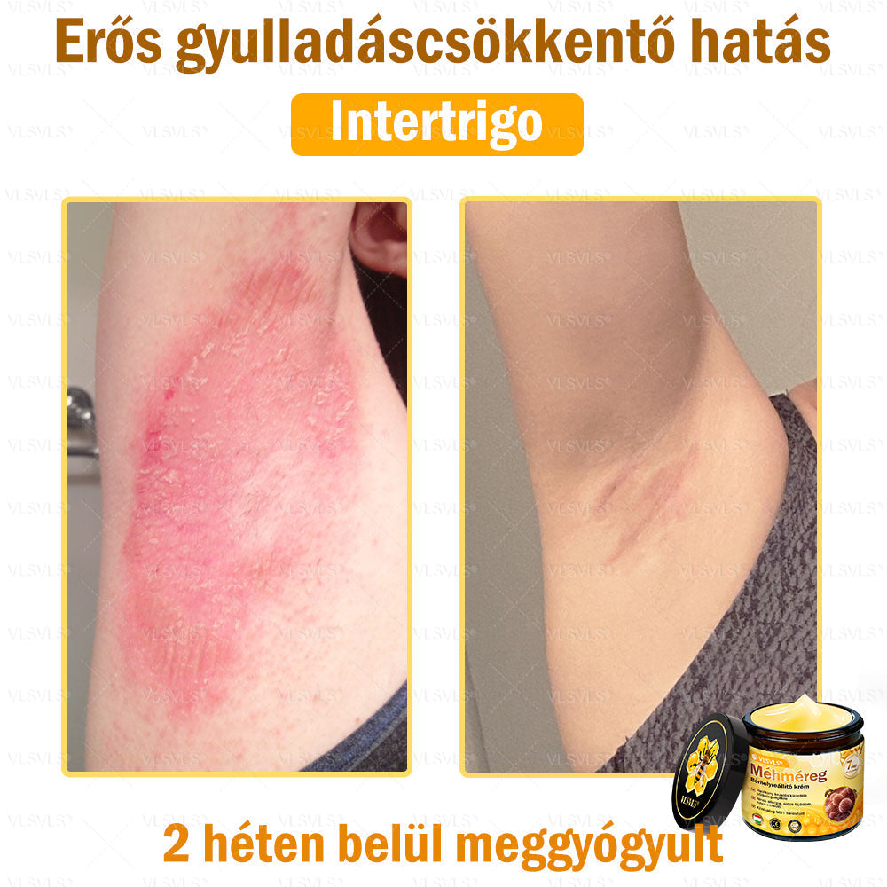 💪VLSVLS® Méhméreg Bőrhelyreállító Krém (👨⚕CE jóváhagyott)👍✅