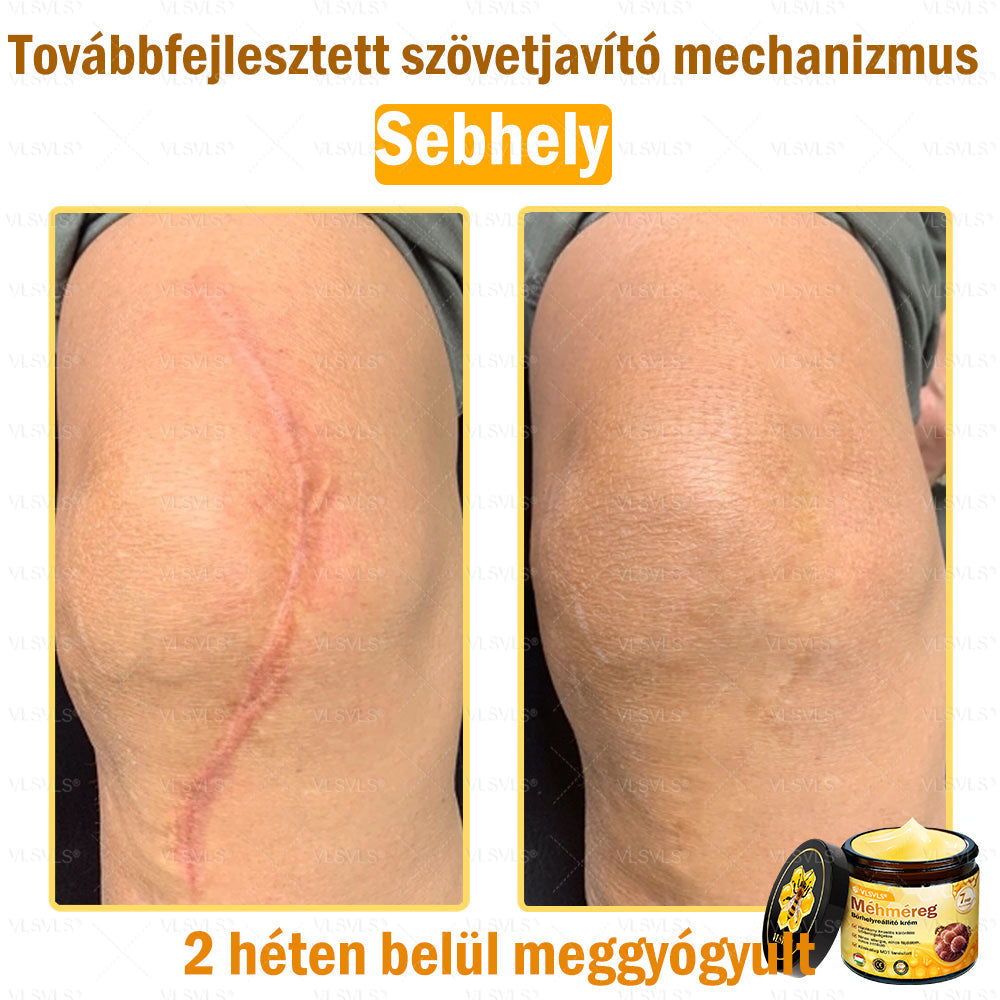 💪VLSVLS® Méhméreg Bőrhelyreállító Krém (👨⚕CE jóváhagyott)👍✅