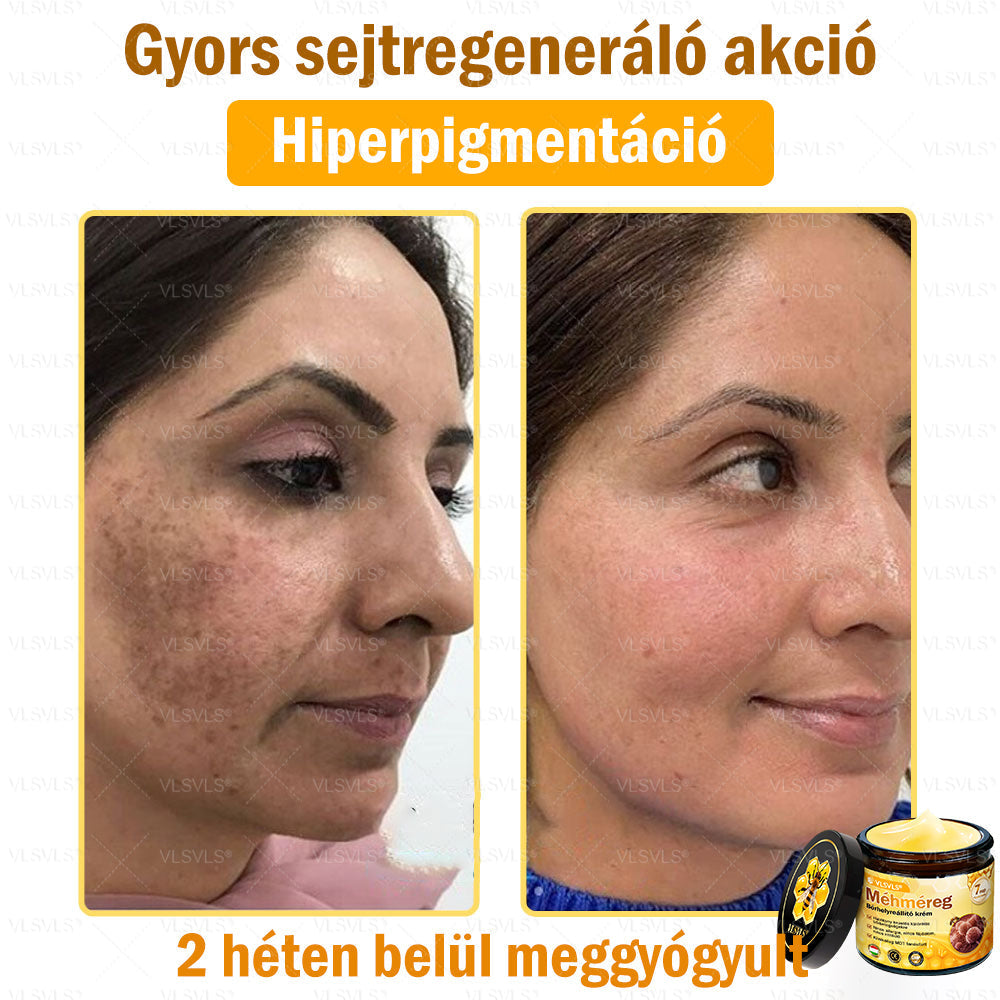 💪VLSVLS® Méhméreg Bőrhelyreállító Krém (👨⚕CE jóváhagyott)👍✅