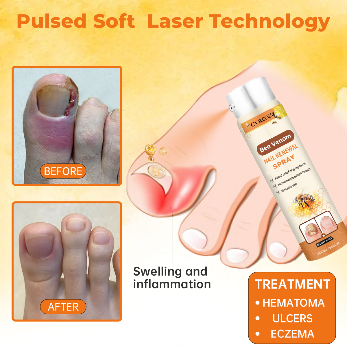 Cvreoz®Bee Venom Nail Renewal Spray👨⚕️ 𝘾𝙚𝙧𝙩𝙞𝙛𝙞𝙚𝙙 𝙗𝙮 𝙩𝙝𝙚 𝘼𝙢𝙚𝙧𝙞𝙘𝙖𝙣 𝘼𝙘𝙖𝙙𝙚𝙢𝙮 𝙤𝙛 𝘿𝙚𝙧𝙢𝙖𝙩𝙤𝙡𝙤𝙜𝙮(𝘼𝘼𝘿)