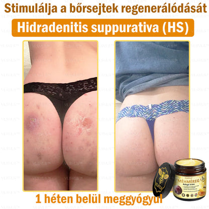 VLSVLS™ Méhméreg Átfogó Krém 🧑‍⚕️ Bőrgyógyászok Által Ajánlott - Különféle bőrproblémák kezelésére 50g