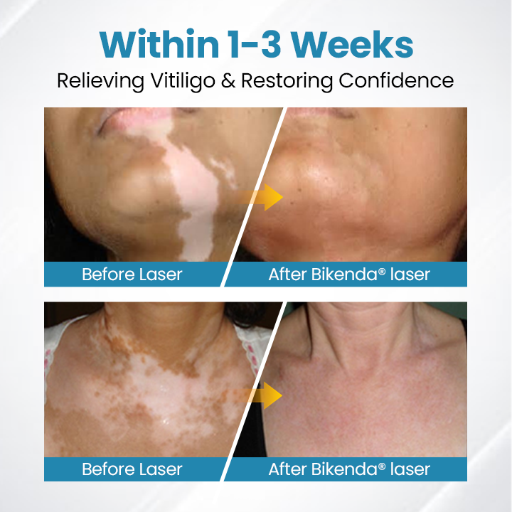 Bikenda® DermaBeam Vitiligo terápiás készülék