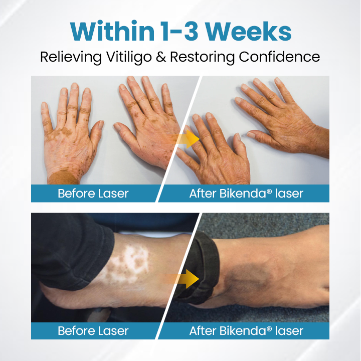 Bikenda® DermaBeam Vitiligo terápiás készülék