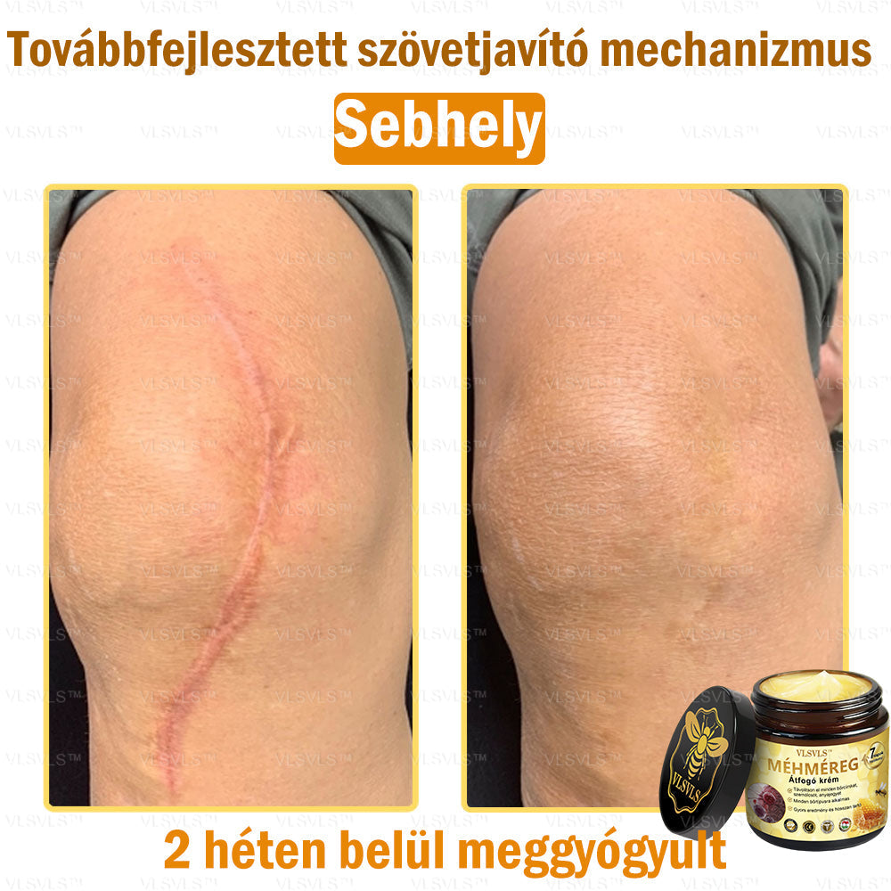 VLSVLS™ Méhméreg Átfogó Krém 🧑‍⚕️ Bőrgyógyászok Által Ajánlott - Különféle bőrproblémák kezelésére 50g