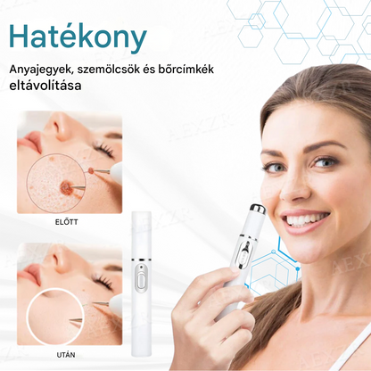 Bikenda® non-invazív anyajegy- és szemölcseltávolító lézertoll
