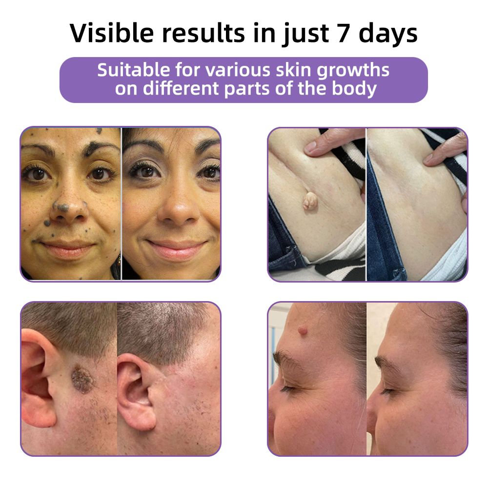 A bőr bizalmának kezdete itt van ✅ Bosstore® Hialuronsav Nano Mikrotűs Javító Tapasz ✴️ Különféle hegekre, striákra, foltokra, keloidokra, keratózisra, aknéra, égési sérülésekre, szemölcsökre, bőrcímkékre és visszértágulatokra.