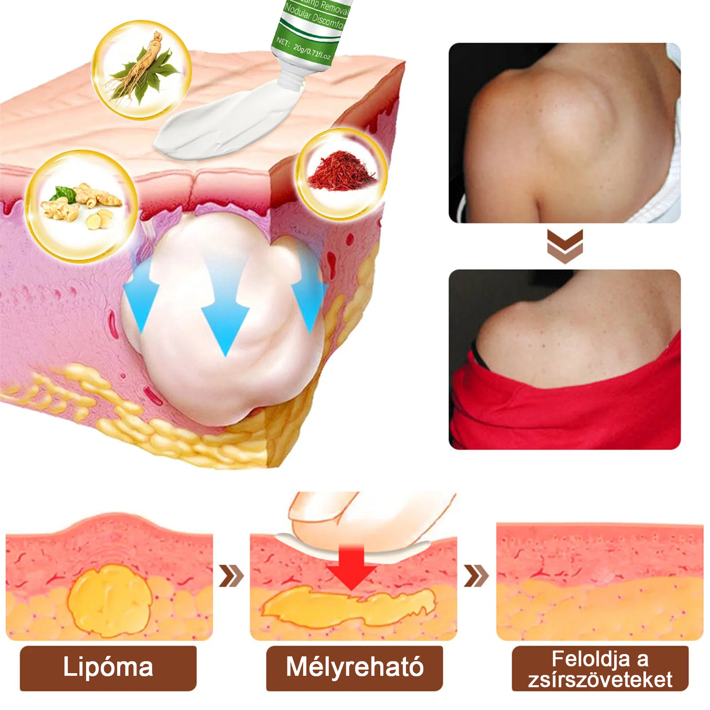 Cvreoz® Lipoma Cure nyugtató kenőcs