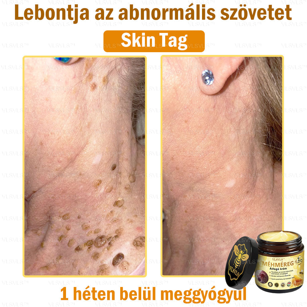 VLSVLS™ Méhméreg Átfogó Krém 🧑‍⚕️ Bőrgyógyászok Által Ajánlott - Különféle bőrproblémák kezelésére 50g