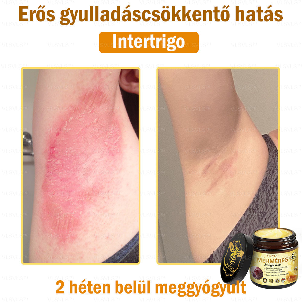 VLSVLS™ Méhméreg Átfogó Krém 🧑‍⚕️ Bőrgyógyászok Által Ajánlott - Különféle bőrproblémák kezelésére 50g