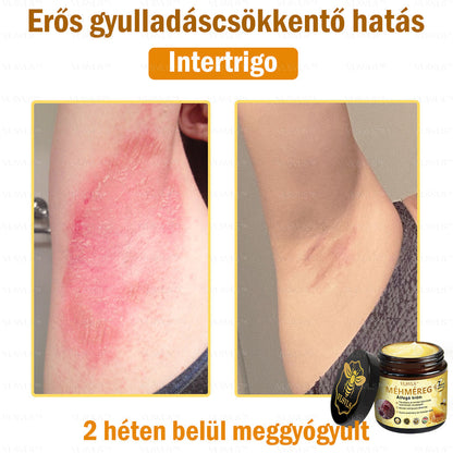 VLSVLS™ Méhméreg Átfogó Krém 🧑‍⚕️ Bőrgyógyászok Által Ajánlott - Különféle bőrproblémák kezelésére 50g