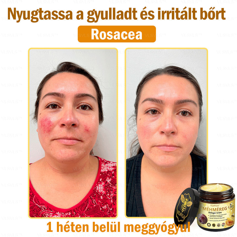 VLSVLS™ Méhméreg Átfogó Krém 🧑‍⚕️ Bőrgyógyászok Által Ajánlott - Különféle bőrproblémák kezelésére 50g