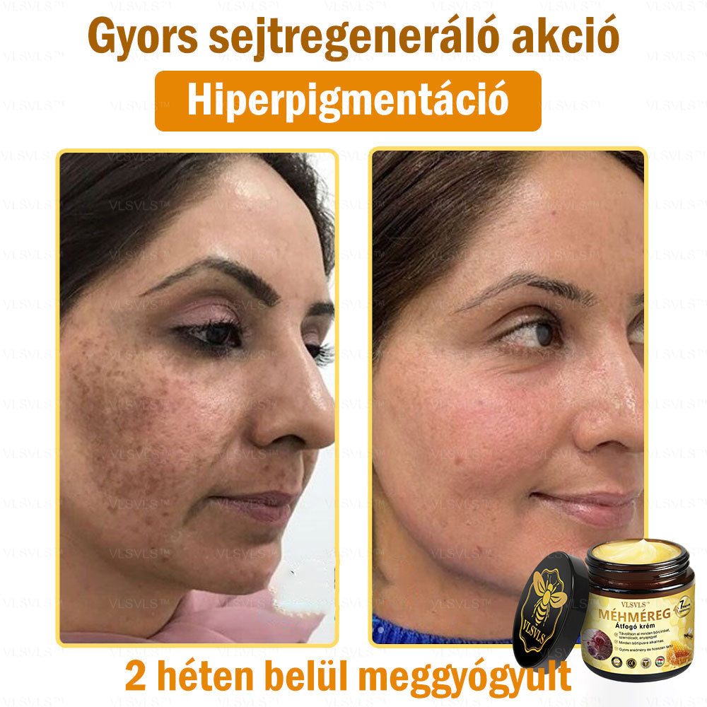 VLSVLS™ Méhméreg Átfogó Krém 🧑‍⚕️ Bőrgyógyászok Által Ajánlott - Különféle bőrproblémák kezelésére 50g