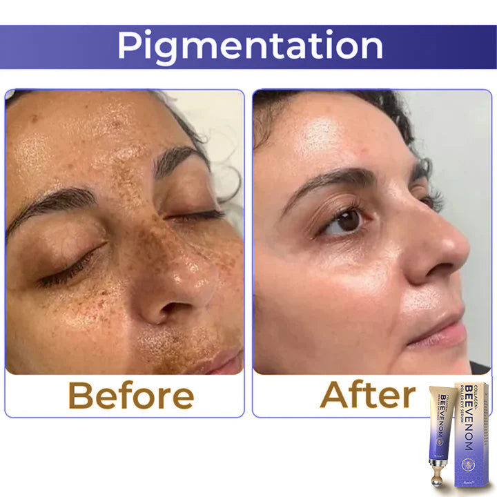🐝 flysmus™ Collagen+ Bee Venom Roller szemkörnyékápoló krém Bőrgyógyász által jóváhagyott