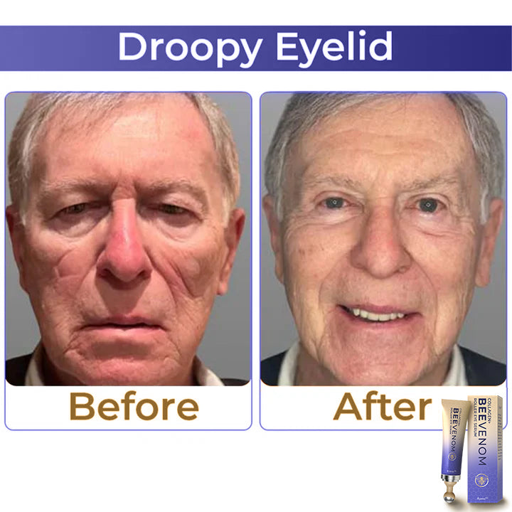 🐝 flysmus™ Collagen+ Bee Venom Roller szemkörnyékápoló krém Bőrgyógyász által jóváhagyott