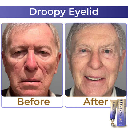 🐝 flysmus™ Collagen+ Bee Venom Roller szemkörnyékápoló krém Bőrgyógyász által jóváhagyott